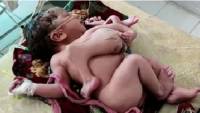 Жительница Индии родила дочь с семью конечностями